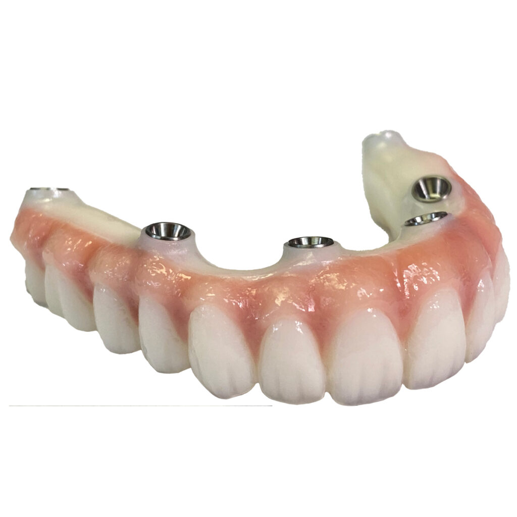 Full Arch Zirconium Implants McDade Dental Studio